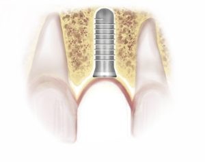 Diagram showing implant placed into the gums