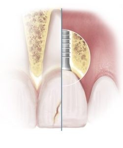Split Diagram Showing Broken Tooth and Replacement Dental Implant